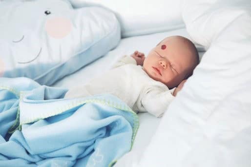 baby with hemangioma