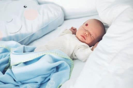 baby with hemangioma