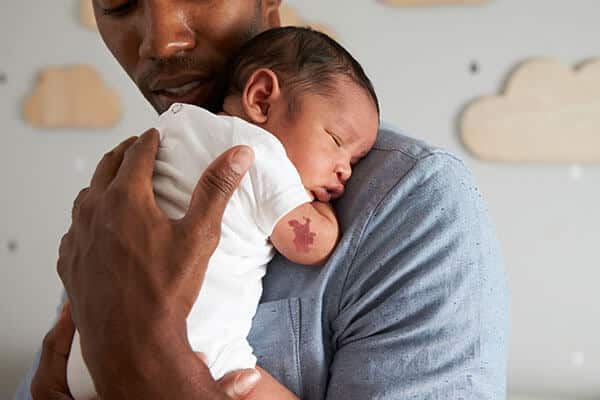 father taking care of baby with infantile hemangioma