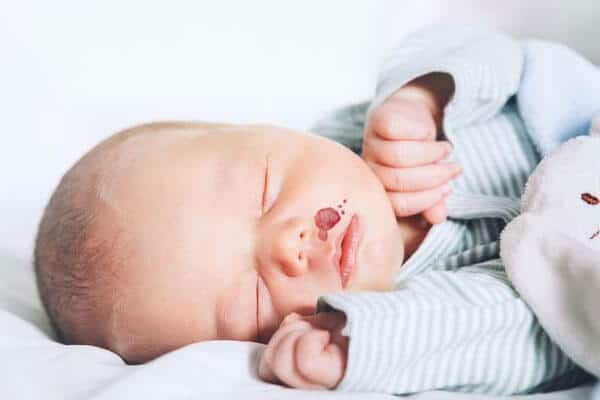 baby suffering from infantile hemangioma