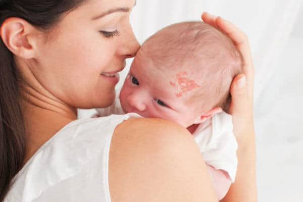 baby with hemangioma on forehead